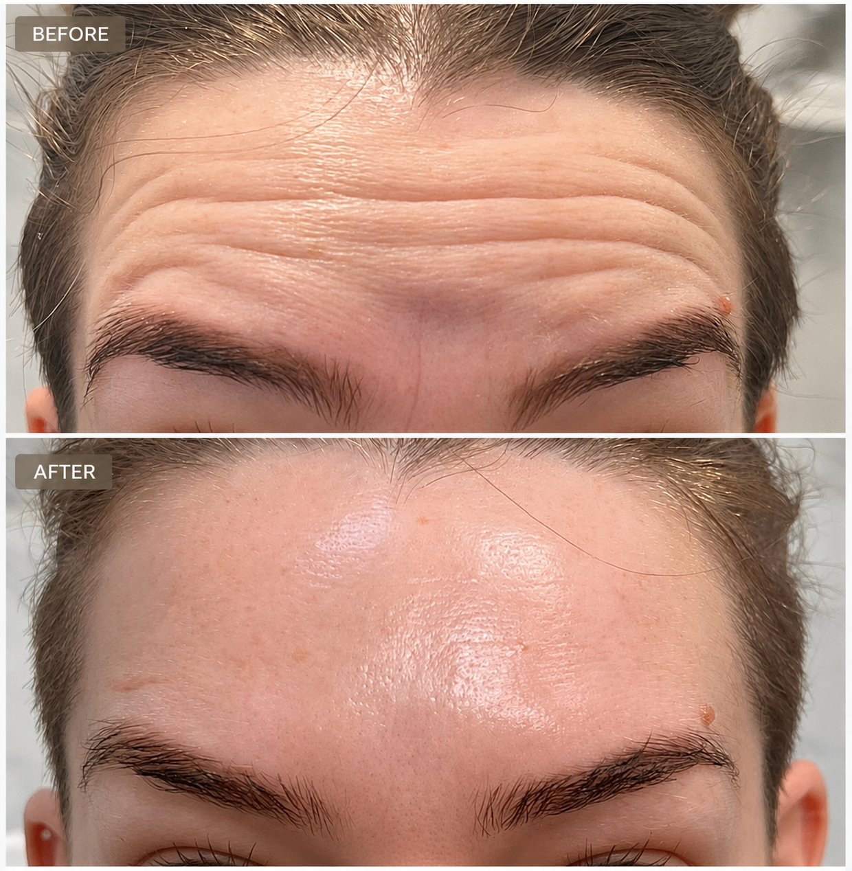 Forehead wrinkle treatment before and after at Luxe Med