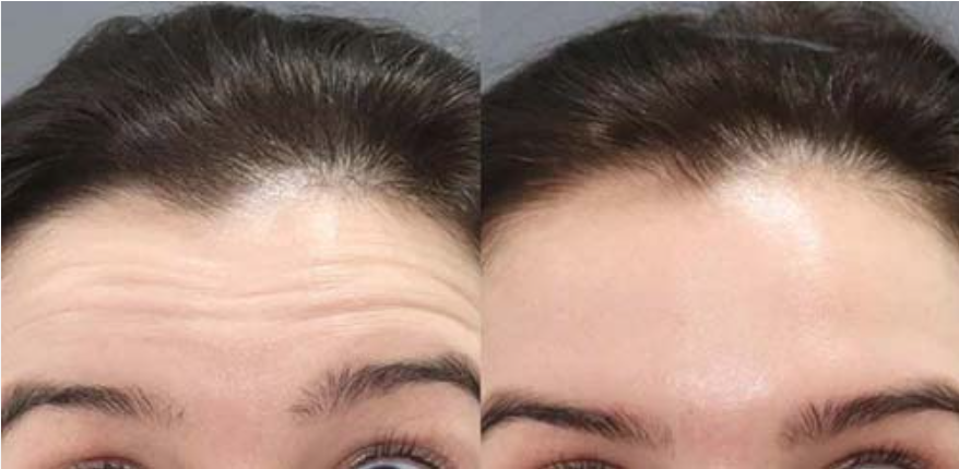 Wrinkle treatment before and after at Luxe Med
