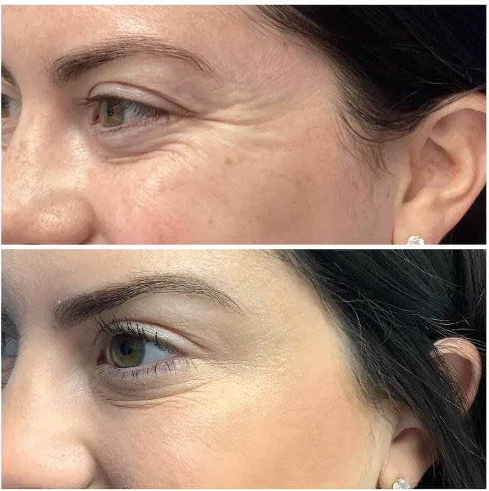 Crow's feet wrinkle treatment before and after at Luxe Med